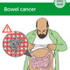 Bowel cancer